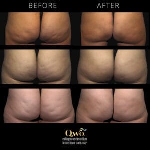Not known Incorrect Statements About Cellulite Reduction Treatments - The American Board Of ...  thumbnail