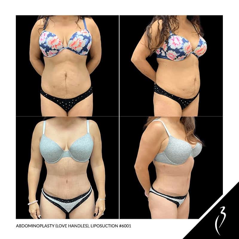 Abdominoplasty Surgery · Before & After Photos · Rancho Cucamonga